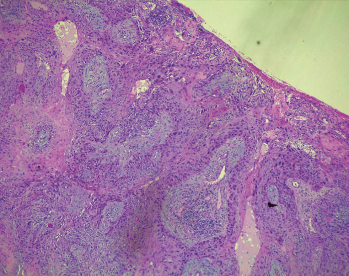 carcinoma-squamoso-congiuntivale-moderatamente-differenziato