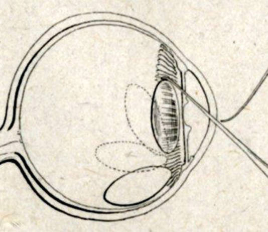 Dove, quando e con quale tecnica è iniziata la chirurgia della cataratta? chirurgia della cataratta