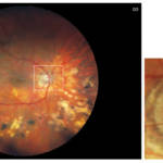 fundus