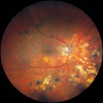 retinopatia-diabetica