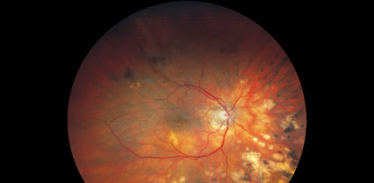 fundus di un paziente affetto da glaucoma