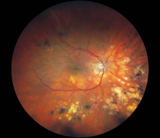 fundus di un paziente affetto da glaucoma