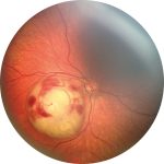 Fig. 1 Immagine Ret-Cam di un bambino affetto da retinoblastoma.