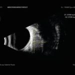 Fig. 1 Ecografia della lesione B-scan (ecogramma che mostra struttura solida, non capsulata, orbitaria extraconica).