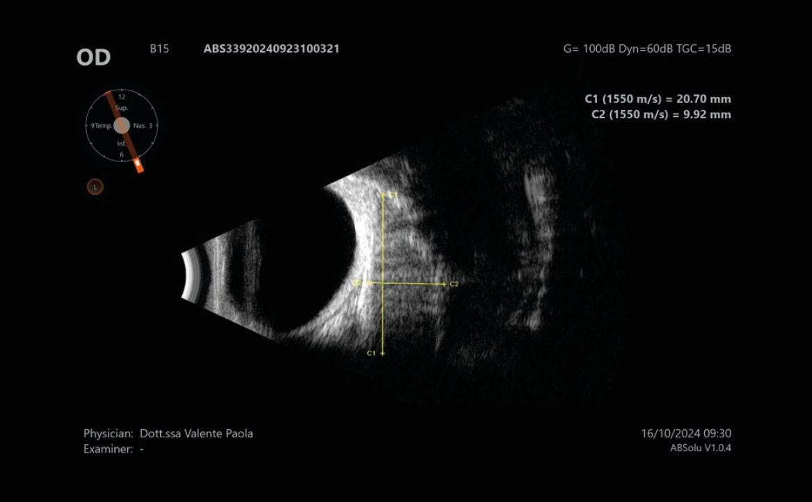 Fig. 1 Ecografia della lesione B-scan (ecogramma che mostra struttura solida, non capsulata, orbitaria extraconica).