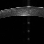 Fig. 1 OCT corneale che evidenzia una irregolarità stromale con alterazione della trasparenza e della pachimetria in OD.
