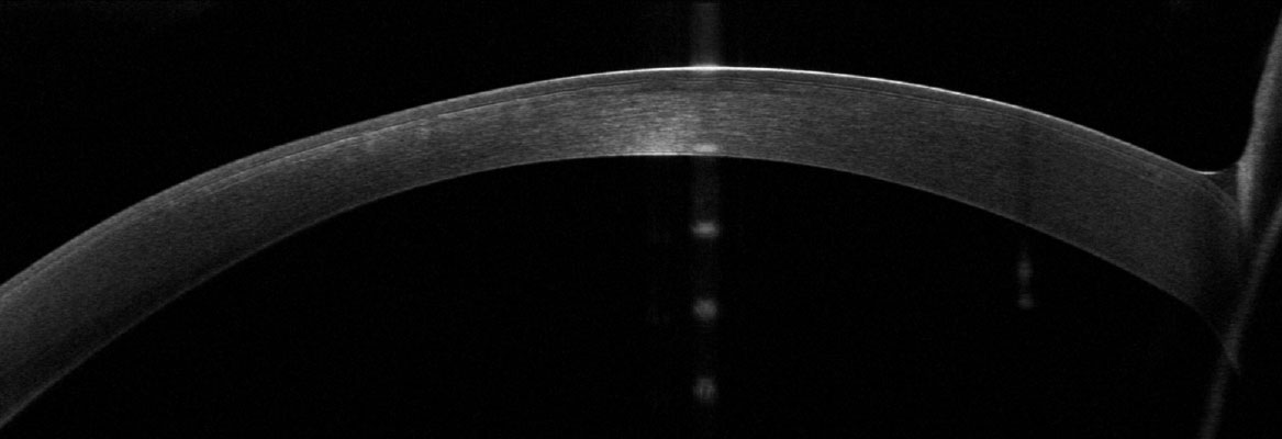 Fig. 1 OCT corneale che evidenzia una irregolarità stromale con alterazione della trasparenza e della pachimetria in OD.