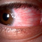 Fig. 1 Iperemia congiuntivale, papille nella regione del limbus di aspetto ialino (noduli di Trantas).