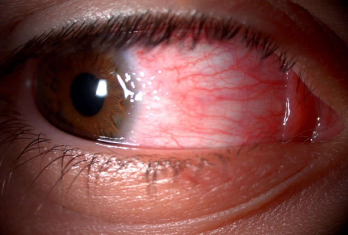 Fig. 1 Iperemia congiuntivale, papille nella regione del limbus di aspetto ialino (noduli di Trantas).