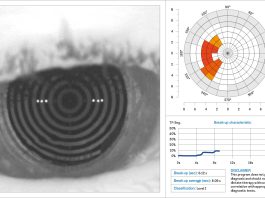 Dry eye e cheratocongiuntivite di Vernal: un case report Fig. 1 N.I.B.U.T. Keratograph M5.