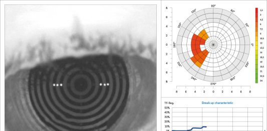 Fig. 1 N.I.B.U.T. Keratograph M5.
