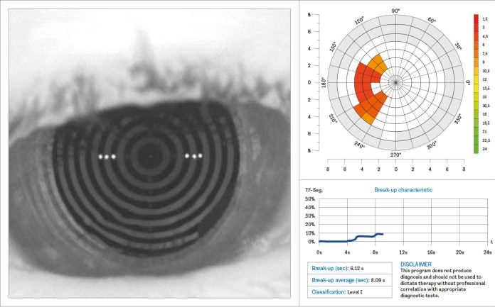 Fig. 1 N.I.B.U.T. Keratograph M5.