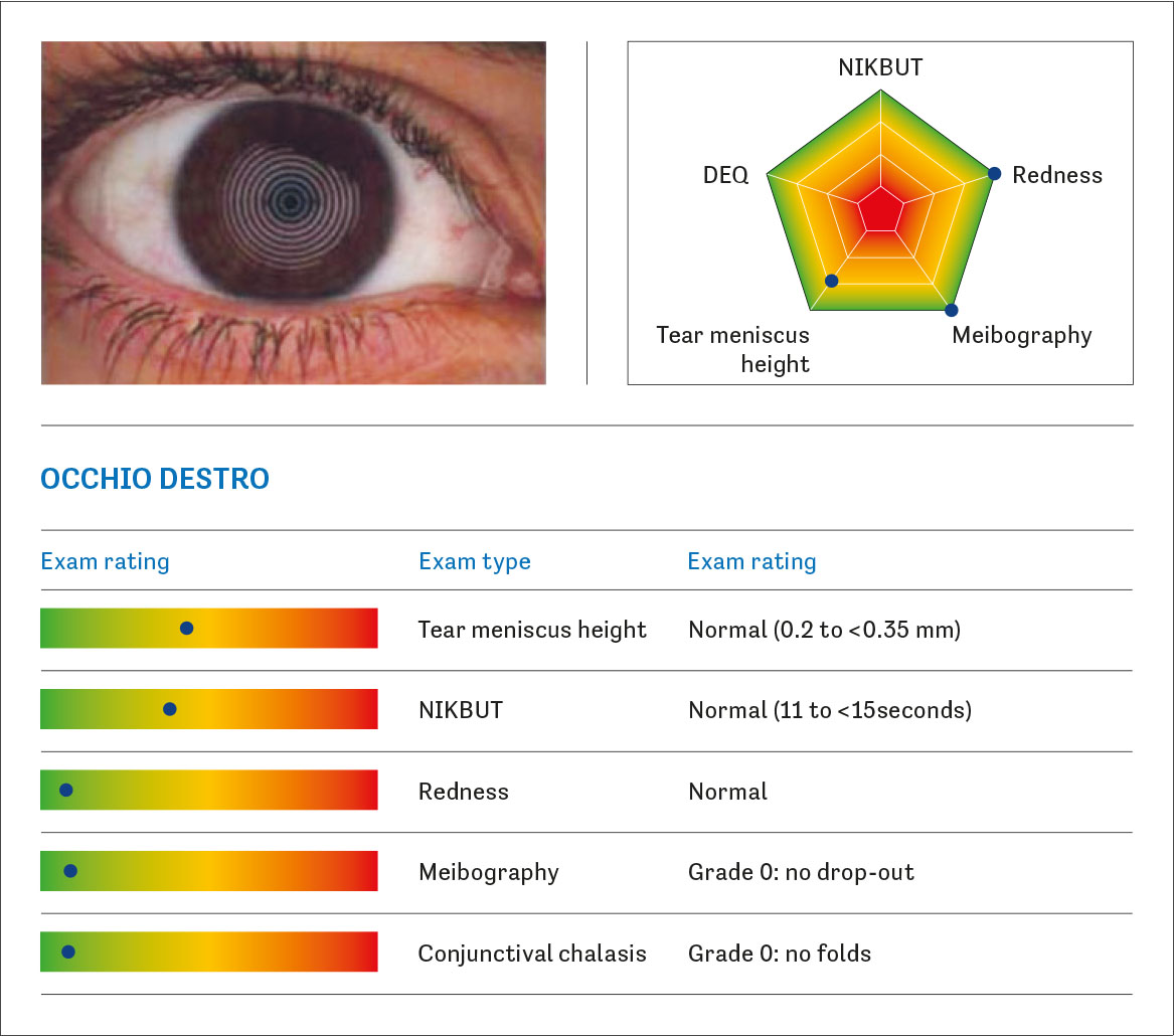 Fig. 1A Dry eye report ottenuto mediante l’utilizzo del Keratograph 5M (Oculus Optikgeräte GmbH, Wetzlar, Germania). Una combinazione di cinque parametri (altezza del menisco lacrimale, break-up time non invasivo, rossore congiuntivale, meibografia e congiuntivochalasi) viene visualizzata su un grafico radar a forma di pentagono.