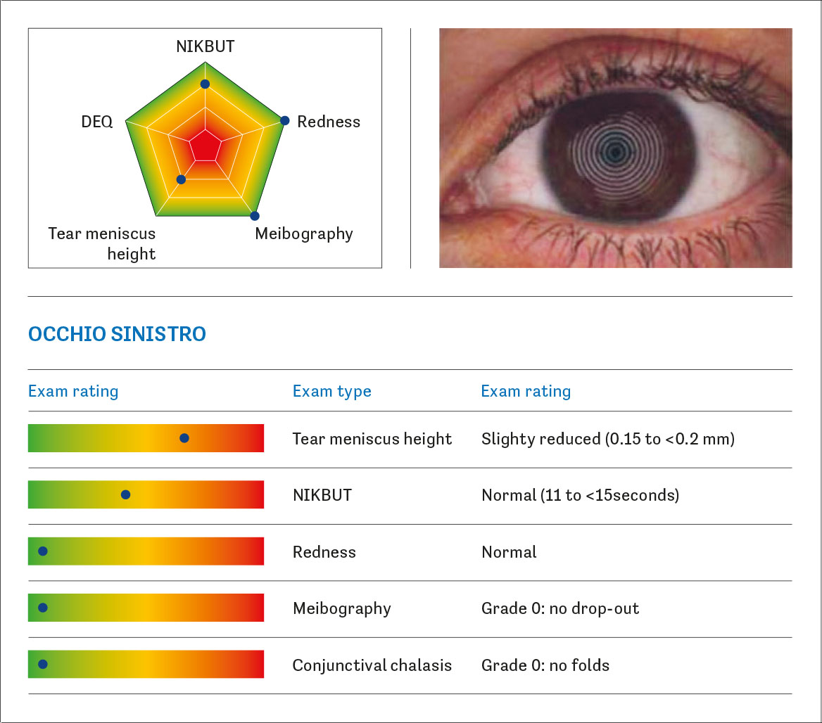 Fig. 1B Dry eye report ottenuto mediante l’utilizzo del Keratograph 5M (Oculus Optikgeräte GmbH, Wetzlar, Germania). Una combinazione di cinque parametri (altezza del menisco lacrimale, break-up time non invasivo, rossore congiuntivale, meibografia e congiuntivochalasi) viene visualizzata su un grafico radar a forma di pentagono.