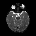 Fig. 2 RMN encefalo con mezzo di contrasto: a carico del globo oculare di sinistra distacco di retina e presenza di lesione sottostante caratterizzata da iperintensità in T1 e ipointensità in T2 rispetto al vitreo, con associati segni di restrizione della diffusione da elevata cellularità, focale deposito di sostanza paramagnetica nel contesto e omogeneo potenziamento contrasto grafico. La lesione deforma il profilo oculare posteriore, lateralmente al nervo ottico.