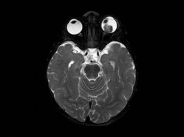 Fig. 2 RMN encefalo con mezzo di contrasto: a carico del globo oculare di sinistra distacco di retina e presenza di lesione sottostante caratterizzata da iperintensità in T1 e ipointensità in T2 rispetto al vitreo, con associati segni di restrizione della diffusione da elevata cellularità, focale deposito di sostanza paramagnetica nel contesto e omogeneo potenziamento contrasto grafico. La lesione deforma il profilo oculare posteriore, lateralmente al nervo ottico.