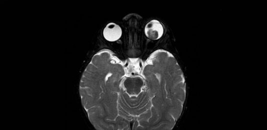 Fig. 2 RMN encefalo con mezzo di contrasto: a carico del globo oculare di sinistra distacco di retina e presenza di lesione sottostante caratterizzata da iperintensità in T1 e ipointensità in T2 rispetto al vitreo, con associati segni di restrizione della diffusione da elevata cellularità, focale deposito di sostanza paramagnetica nel contesto e omogeneo potenziamento contrasto grafico. La lesione deforma il profilo oculare posteriore, lateralmente al nervo ottico.