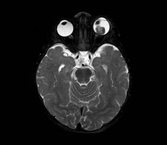 Fig. 2 RMN encefalo con mezzo di contrasto: a carico del globo oculare di sinistra distacco di retina e presenza di lesione sottostante caratterizzata da iperintensità in T1 e ipointensità in T2 rispetto al vitreo, con associati segni di restrizione della diffusione da elevata cellularità, focale deposito di sostanza paramagnetica nel contesto e omogeneo potenziamento contrasto grafico. La lesione deforma il profilo oculare posteriore, lateralmente al nervo ottico.