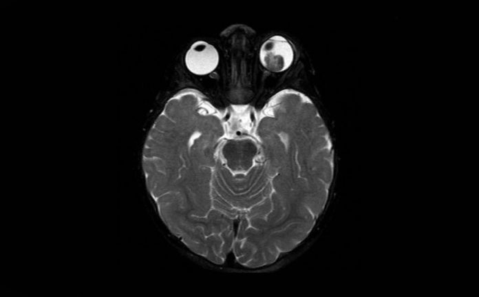 Fig. 2 RMN encefalo con mezzo di contrasto: a carico del globo oculare di sinistra distacco di retina e presenza di lesione sottostante caratterizzata da iperintensità in T1 e ipointensità in T2 rispetto al vitreo, con associati segni di restrizione della diffusione da elevata cellularità, focale deposito di sostanza paramagnetica nel contesto e omogeneo potenziamento contrasto grafico. La lesione deforma il profilo oculare posteriore, lateralmente al nervo ottico. Fig. 2 RMN encefalo con mezzo di contrasto: a carico del globo oculare di sinistra distacco di retina e presenza di lesione sottostante caratterizzata da iperintensità in T1 e ipointensità in T2 rispetto al vitreo, con associati segni di restrizione della diffusione da elevata cellularità, focale deposito di sostanza paramagnetica nel contesto e omogeneo potenziamento contrasto grafico. La lesione deforma il profilo oculare posteriore, lateralmente al nervo ottico.