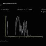 Fig. 2 Ecografia della lesione A-scan (ecogramma che mostra struttura a bassa reflettività, irregolare con angolo K negativo).