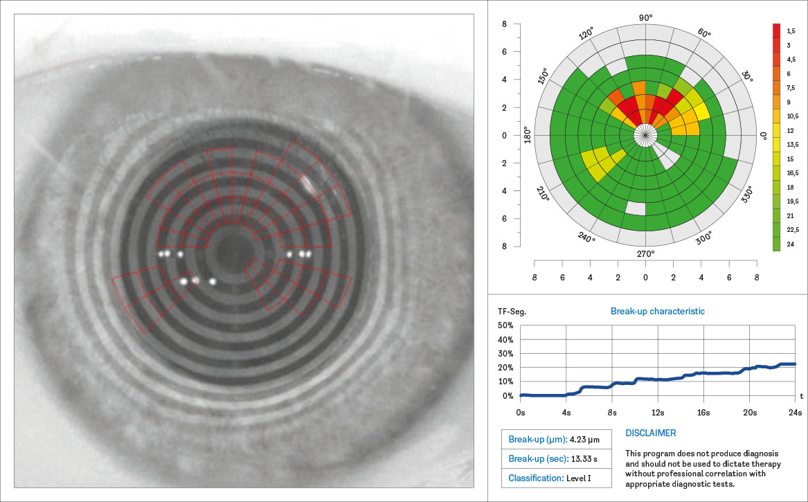 Fig. 2 Esame NIBUT (Non-Invasive Break-Up Time) effettuato con un dispositivo Oculus Keratograph 5M, utilizzato per valutare la stabilità del film lacrimale senza l’uso di fluoresceina.