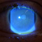 Fig. 2 Cheratite profonda interessante l’asse visivo e i settori centrali e inferiori corneali in OD.