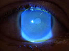 Fig. 2 Cheratite profonda interessante l’asse visivo e i settori centrali e inferiori corneali in OD.