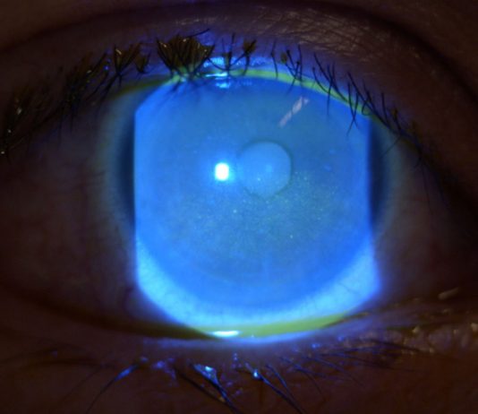 Fig. 2 Cheratite profonda interessante l’asse visivo e i settori centrali e inferiori corneali in OD.