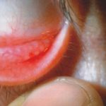 Fig. 2A Ipertrofia papillare al tarso inferiore, presenza di papille giganti e filamenti mucosi al tarso superiore.