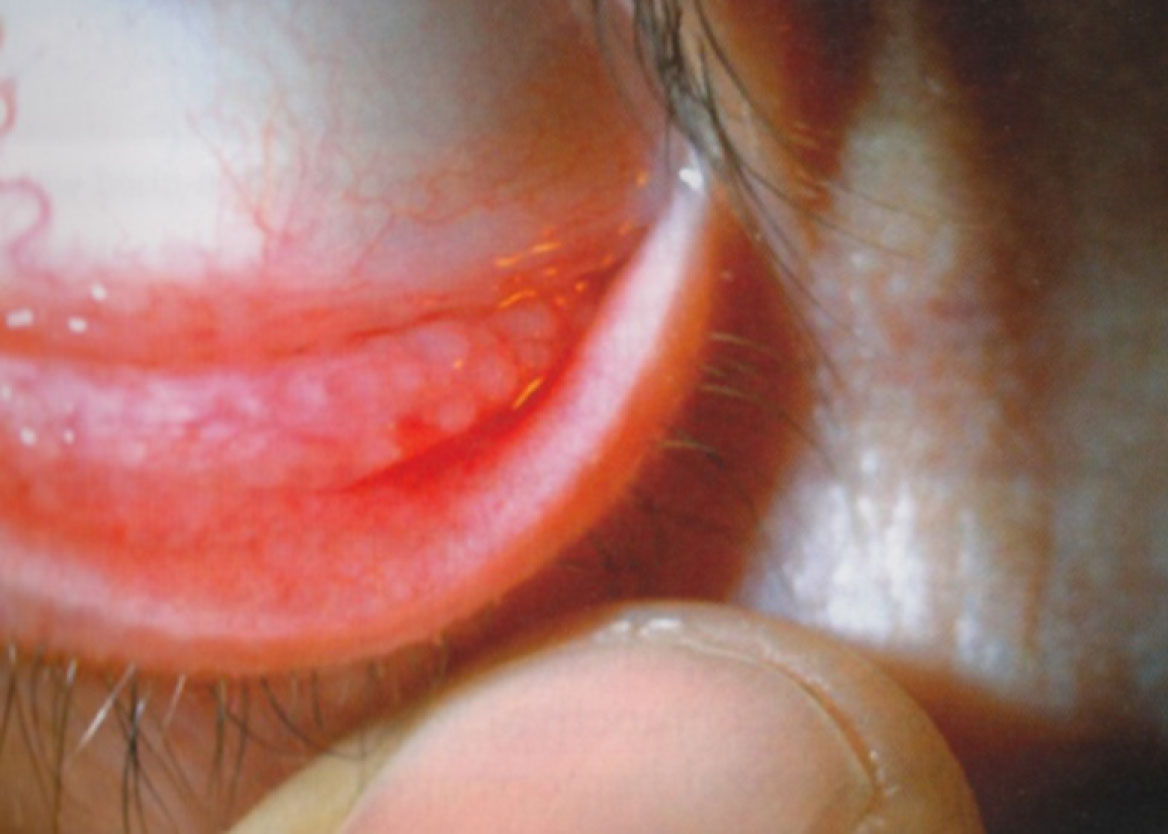 Fig. 1 Iperemia congiuntivale, papille nella regione del limbus di aspetto ialino (noduli di Trantas).