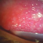 Fig. 2B Ipertrofia papillare al tarso inferiore, presenza di papille giganti e filamenti mucosi al tarso superiore.