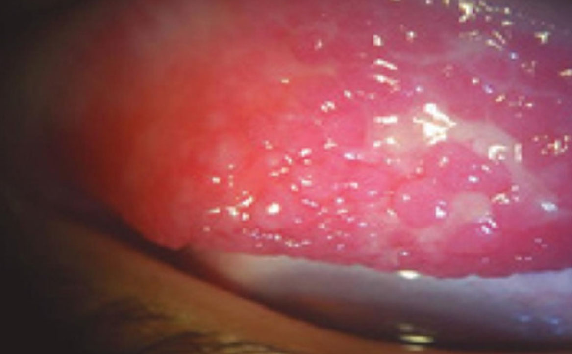 Fig. 1 Iperemia congiuntivale, papille nella regione del limbus di aspetto ialino (noduli di Trantas).