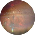 Fig. 2 Retinografia del fondo oculare di un paziente con uveite intermedia, evidenziando la presenza di snowballs nella periferia inferiore.