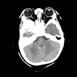 Fig. 3 TC encefalo/orbite con evidenza della neoformazione orbitaria (sezione assiale della TC evidenziante la lesione extraconica).