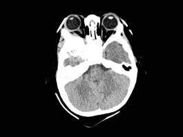 Fig. 3 TC encefalo/orbite con evidenza della neoformazione orbitaria (sezione assiale della TC evidenziante la lesione extraconica).