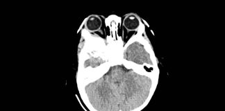 Fig. 3 TC encefalo/orbite con evidenza della neoformazione orbitaria (sezione assiale della TC evidenziante la lesione extraconica).