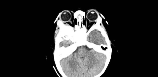 Fig. 3 TC encefalo/orbite con evidenza della neoformazione orbitaria (sezione assiale della TC evidenziante la lesione extraconica).