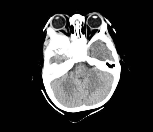 Fig. 3 TC encefalo/orbite con evidenza della neoformazione orbitaria (sezione assiale della TC evidenziante la lesione extraconica).