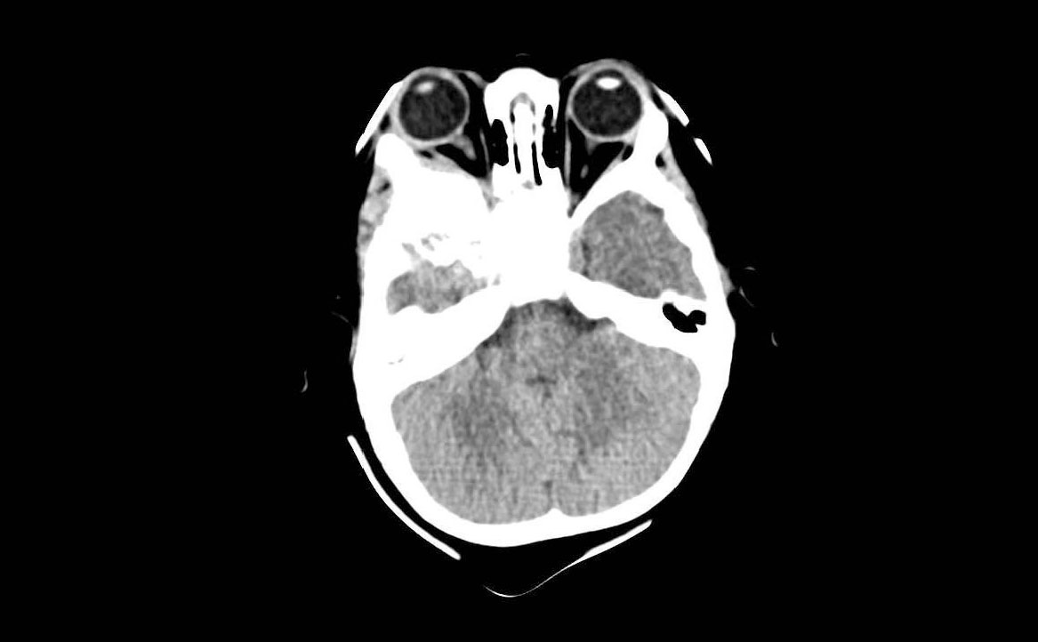 Fig. 3 TC encefalo/orbite con evidenza della neoformazione orbitaria (sezione assiale della TC evidenziante la lesione extraconica).