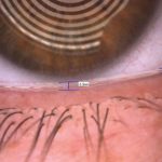 Fig. 3 Valutazione del tear meniscus tramite Keratograph 5M (Oculus).