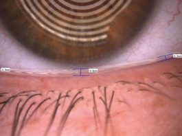 Fig. 3 Valutazione del tear meniscus tramite Keratograph 5M (Oculus).