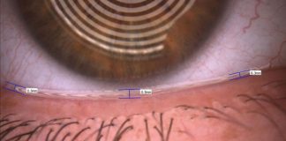 Fig. 3 Valutazione del tear meniscus tramite Keratograph 5M (Oculus).
