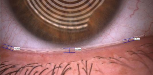 Fig. 3 Valutazione del tear meniscus tramite Keratograph 5M (Oculus).