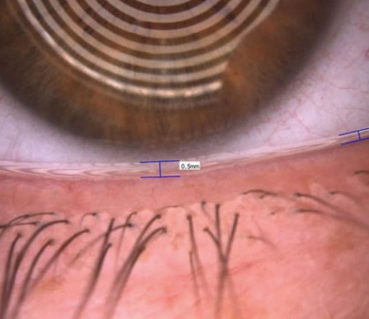 Fig. 3 Valutazione del tear meniscus tramite Keratograph 5M (Oculus).