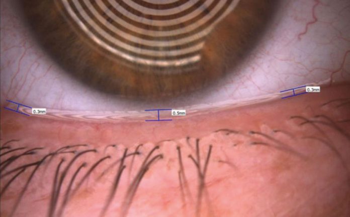 Fig. 3 Valutazione del tear meniscus tramite Keratograph 5M (Oculus).