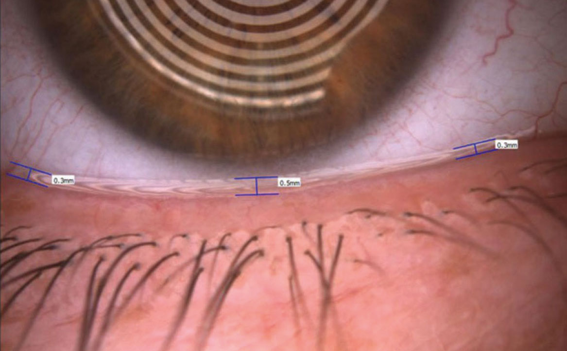 Fig. 3 Valutazione del tear meniscus tramite Keratograph 5M (Oculus).