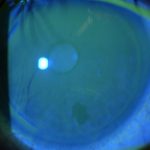 Fig. 3 Staining corneale e distribuzione irregolare del film lacrimale in OS.