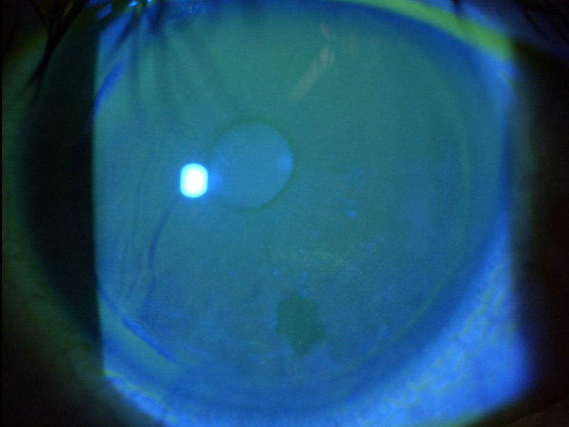 Fig. 3 Staining corneale e distribuzione irregolare del film lacrimale in OS.