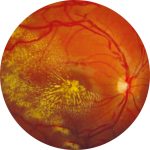 Fig. 3A Esame Ret-Cam di un bambino di 6 anni affetto da malattia di Leber-Coats laser-trattata.