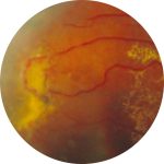 Fig. 3B Esame Ret-Cam di un bambino di 6 anni affetto da malattia di Leber-Coats laser-trattata.